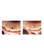 Opalescence ® Endo do wybielania martwych zębów